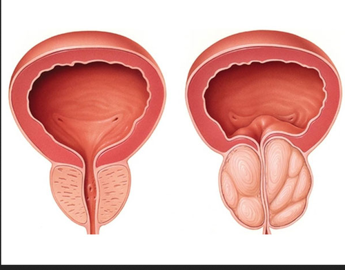 Papillary lesion prostate,, Papillary lesion prostate