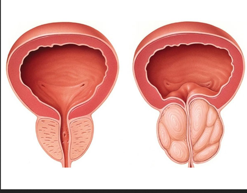 hiperplasia prostata cie 10)