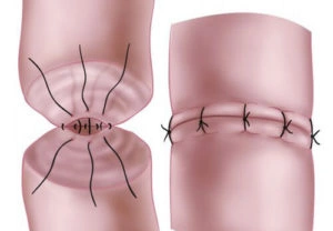 Reversão de vasectomia para alívio da dor pós-operatória: um procedimento que não funciona para todos os casos.