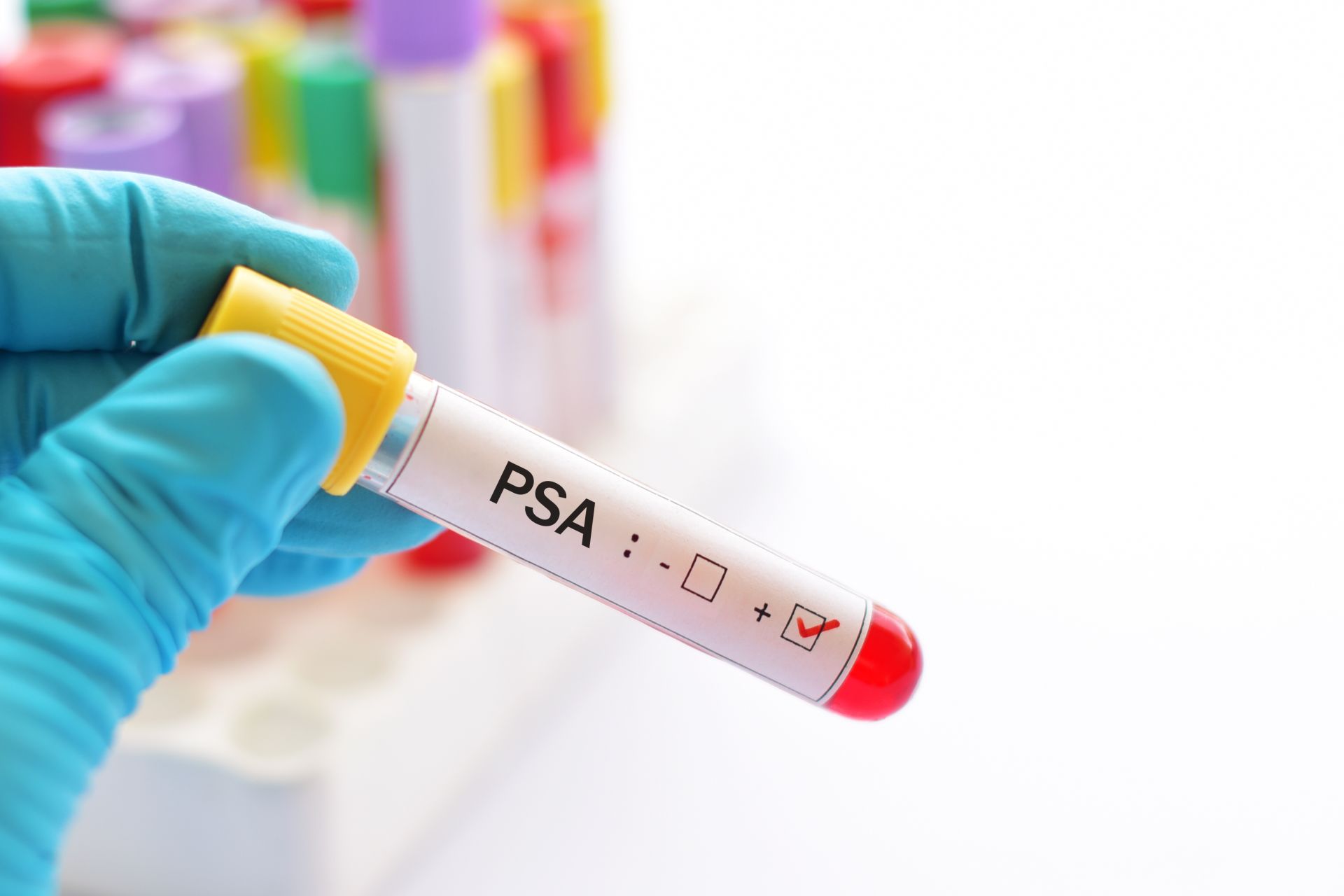 Blood sample positive with PSA (Prostate-specific antigen) test