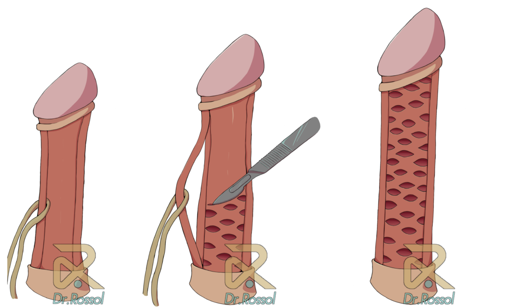 Doença de Peyronie - Dr. Rossol - Especialista em Porto Alegre